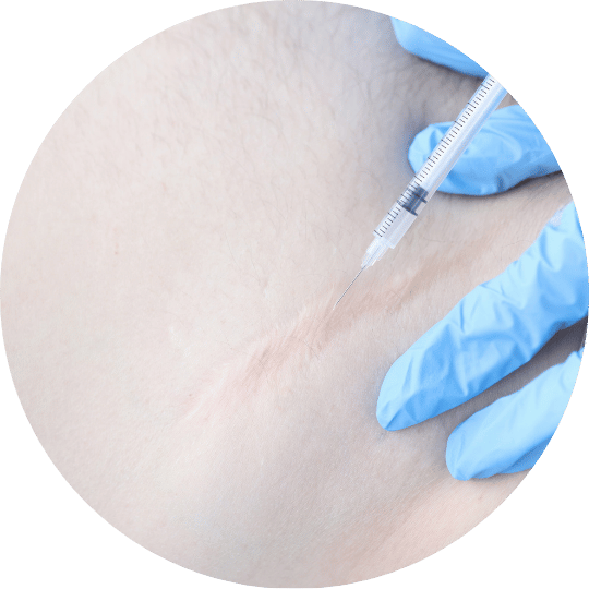 KELOID INJECTION