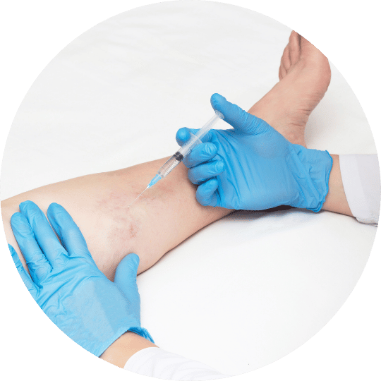 Sclerotherapy